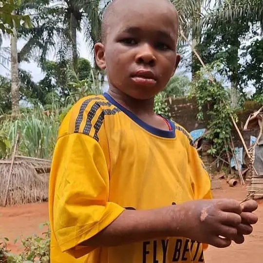 10-year-old boy abused by guardians discharged from hospital in Anambra